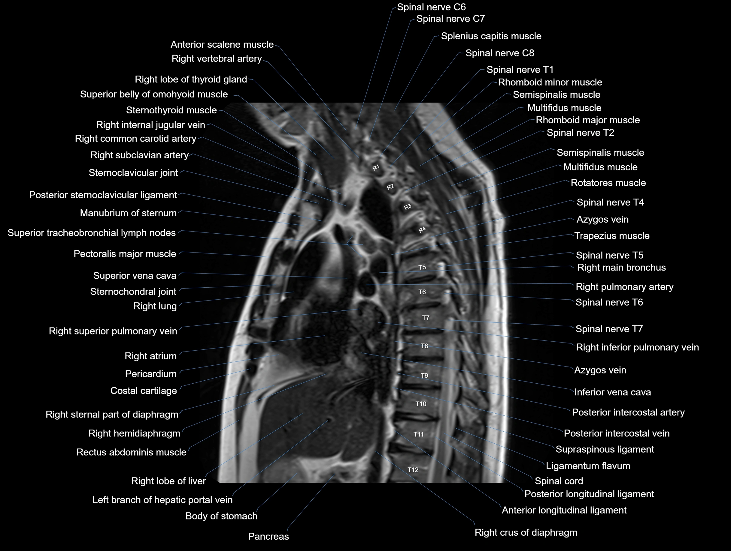 MRI chest (thorax) coronal  cross sectional anatomy 3T radiology  image-img-00001-00018.webp